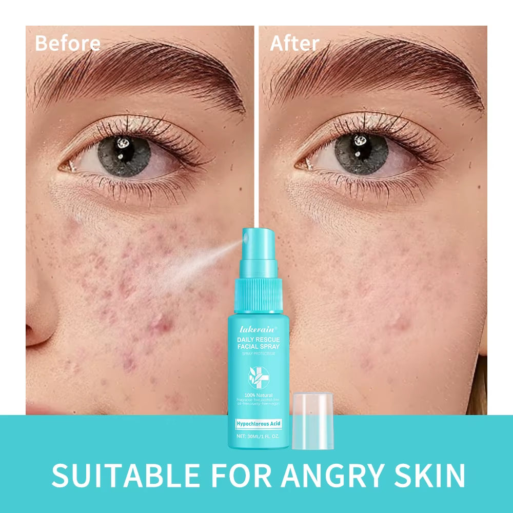Calming Rescue Facial Spray for Sensitive Skin Hypochlorous Acid Spray Helps Reduce Redness Breakouts Soothing Balancing Spray