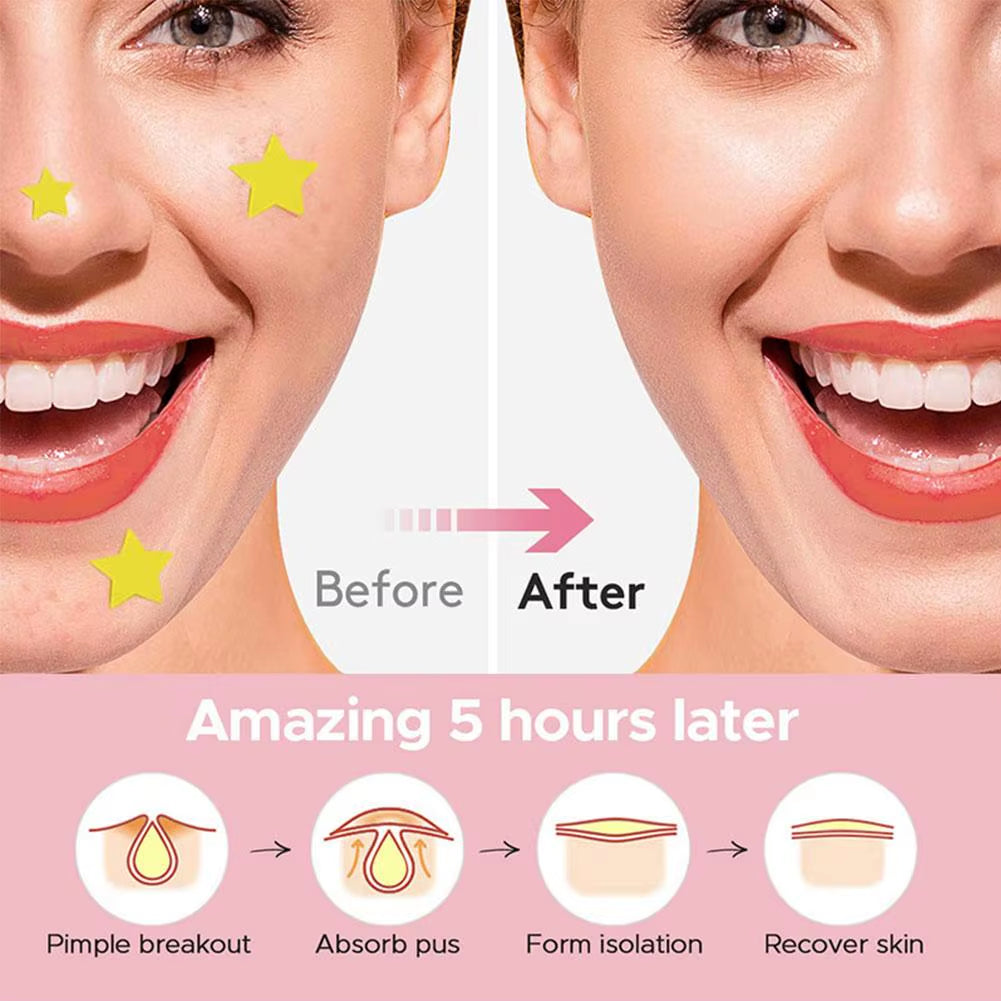 600 Counts Colorful Star Spot Acne/Pimple Patch for Face, Hydrocolloid Cute Star Shaped Acne Patch Invisible Zit Cover Stickers